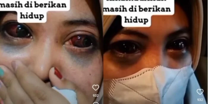 Korban Tragedi Kanjuruhan, Hijaber Cantik Ini Alami Mata Merah dan Kantung Matanya Hitam Kebiruan