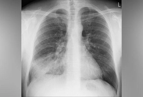 Pemerintah Laporkan 6 Kasus Mycoplasma Pneumoniae di Jakarta