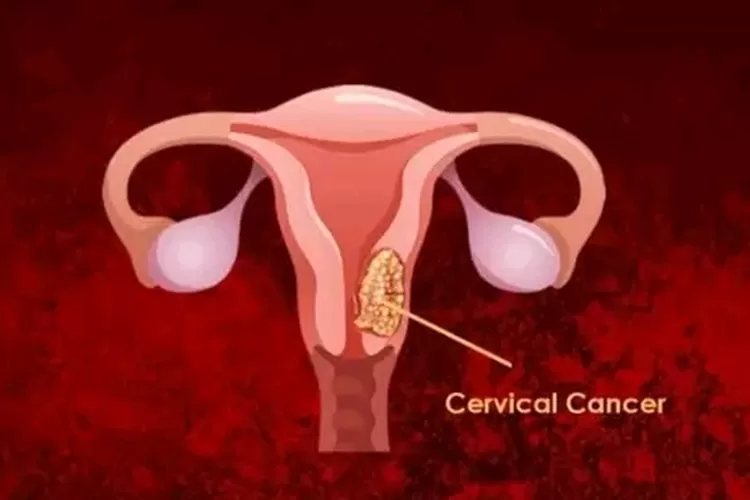 Kanker Serviks Dominasi Proporsi Kasus Kanker, Sering Ditemukan di Indonesia