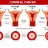 Awal Mula Kanker Serviks dari Infeksi Human Papillomavirus pada Leher Rahim yang Normal, Perkembangannya Dapat Dicegah